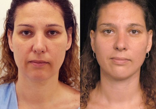 Do facelifts look unnatural?