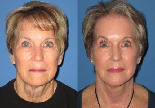 What is the Best Age for a Mini Facelift?