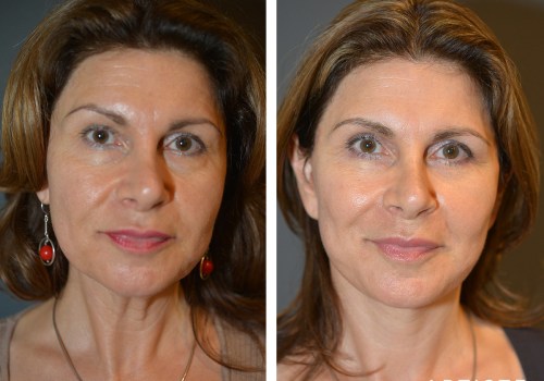 How Long Does a Facelift Last?