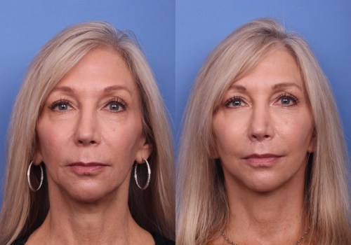 How Long Does a Facelift Make You Look Younger?