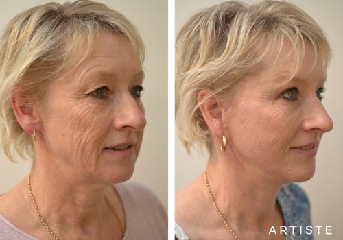 What is the Optimal Age for a Facelift?