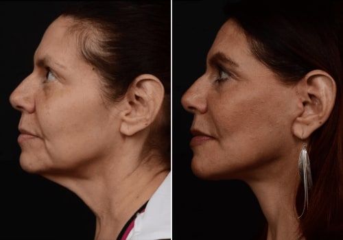 What is the success rate of a facelift?