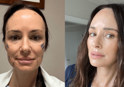 Are face lifts obvious?
