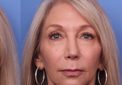 The Truth About Facelifts: Debunking the Myths and Revealing the Facts