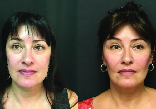 What is the Longest Lasting Facelift?