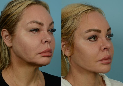 Do i really need a facelift?