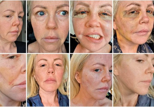 How Long Does it Take to See the Final Results of a Facelift?